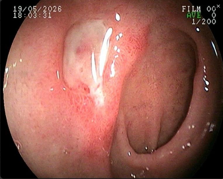 Imagem de endoscopia digestiva alta — úlcera de bulbo duodenal